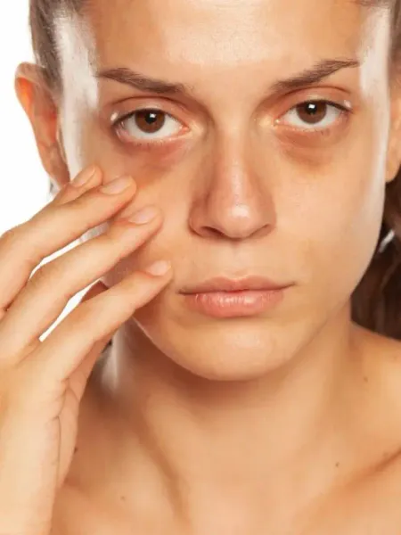 Dark Circles Treatment Vitamin E Argon Rose Olive Almond Tea Tree Oil Benefits Beauty Tips