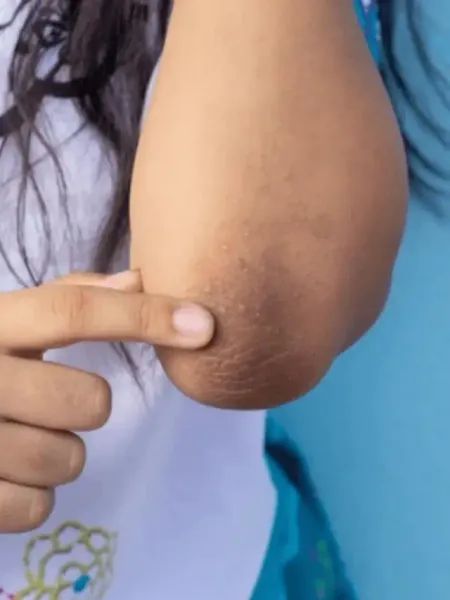 Dark Elbow Brightening tips