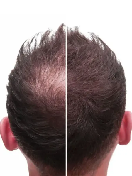 Tomato Juice Hair Growth Tips Benefits