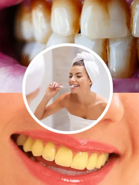 Gutka, Pan Masala Spoilt Your Teeth, Here's How to Make Them Sparkling Clean