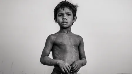 Malnutrition कुपोषण 