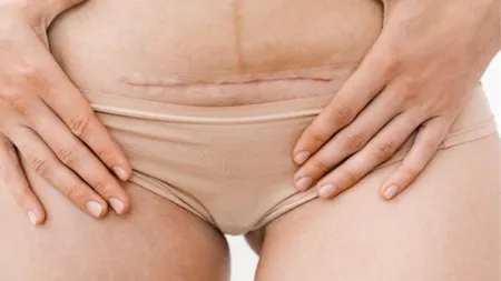 C-section  (Pinterest)