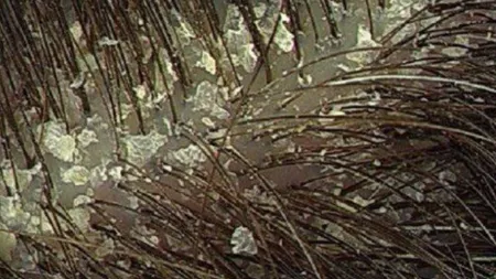 Dandruff (Pinterest)