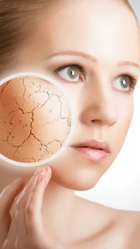 Dehydrated Skin