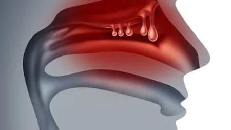 Nasal Congestion (PInterest).png