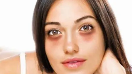 Dark Circles (Pinterest).png