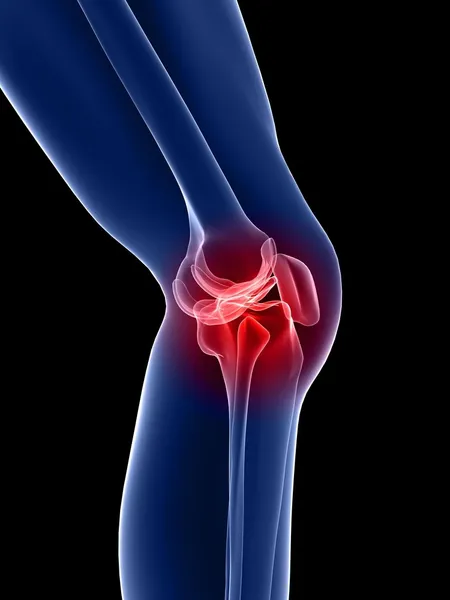 knee-pain