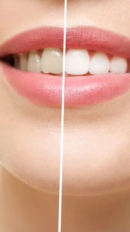 Yellow teeth 