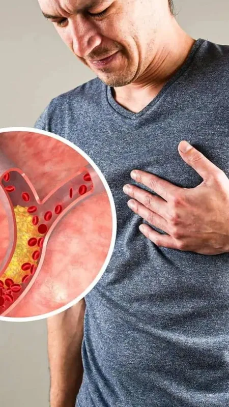 high cholesterol symptoms 1