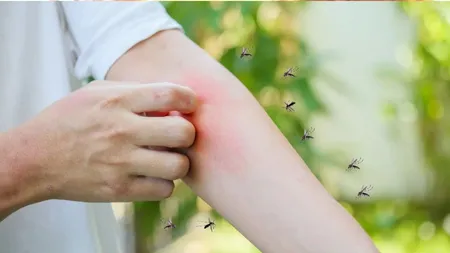 mosquitoes bite