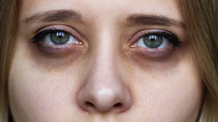 dark circles