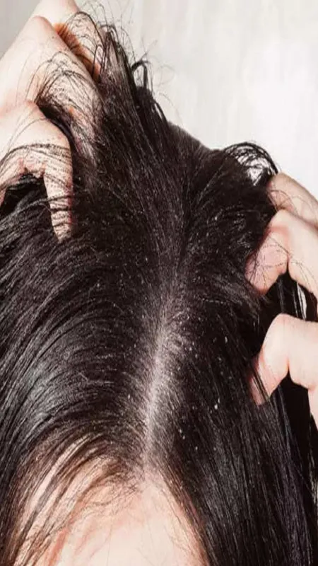 इस नुस्खे को आजमाएं, सिर के डैंड्रफ से छुटकारा पाएं