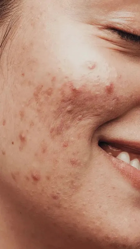 फेस पर लगाएं ये चीजें पिंपल्स तुरंत हो जाएंगे गायब!