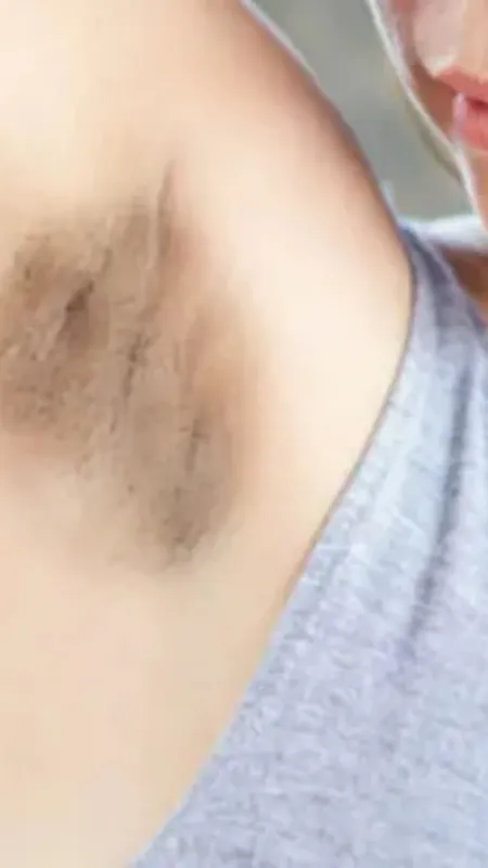 क्या आप भी अंडरआर्म्स पिग्मेंटेशन की वजह से नहीं पहन पाती स्लीवलेस ड्र