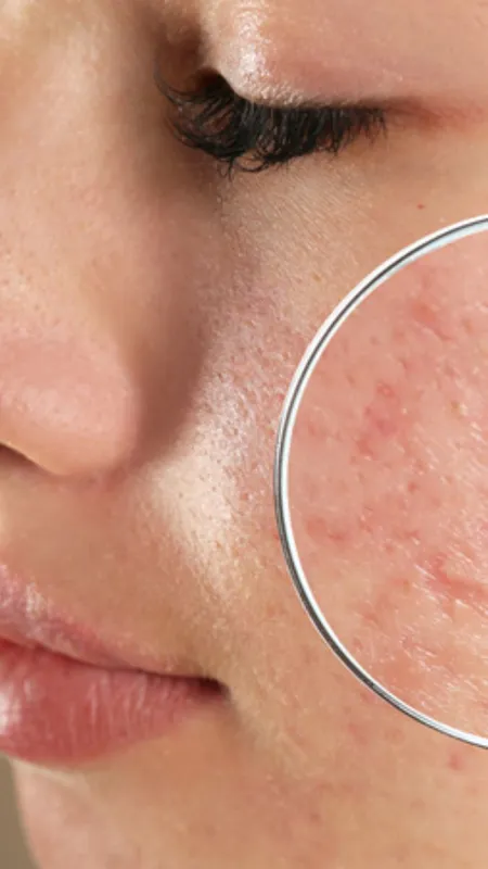 इन 8 टिप्स से पाएं एक्ने से छुटकारा, चेहरा हो जाएगा साफ