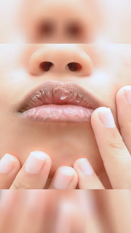 आपके होंठ फटने के पीछे कहीं ये अनजान रीज़न्स तो नहीं