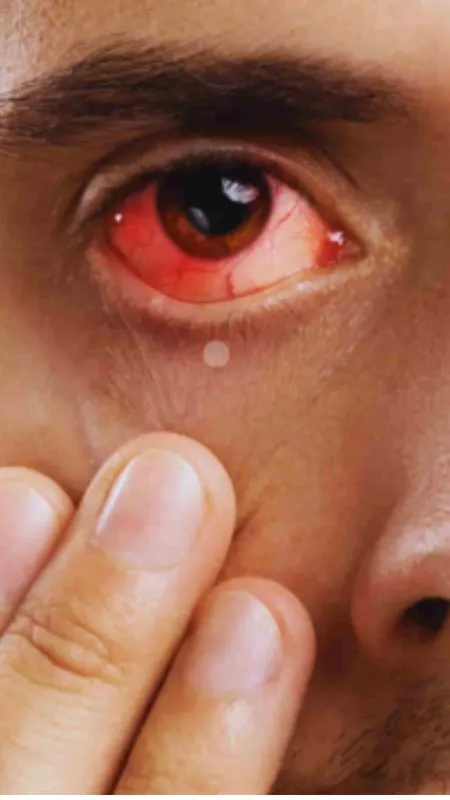 आई फ्लू से इस तरह करें खुद का बचाव!