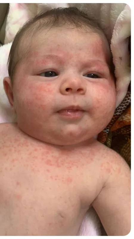 बच्चों की घमौरियां दूर करने के ये हैं घरेलू उपाय