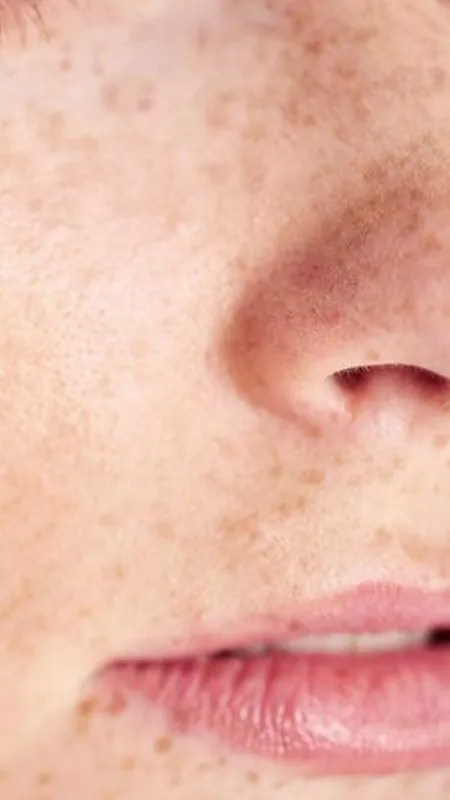 Beauty Tips: Blackheads का करें उपाय,पाएं इनसे छुट्टी