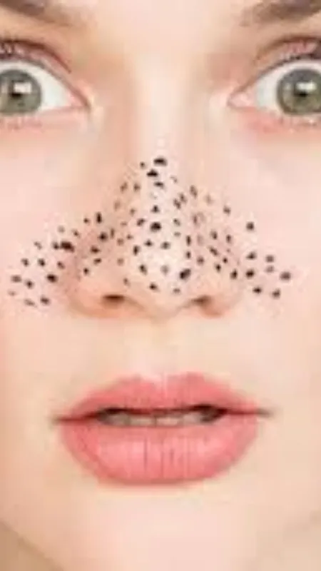 ब्लैकहेड्स से छुटकारा पाने के लिए अपनाएं ये तरीकें