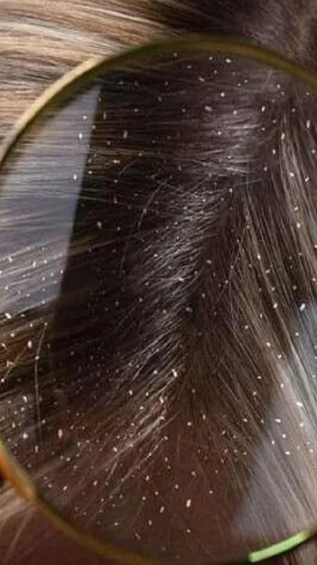 Dandruff का करें सफाया, अपनाएं ये घरेलु तरकीब!