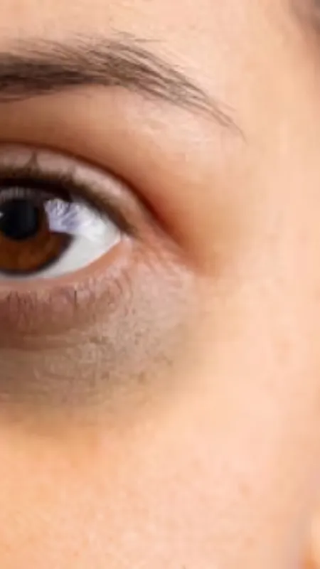 क्यों आंखों के नीचे हो जाते हैं डार्क सर्कल्स, मिल गया है इसका जवाब