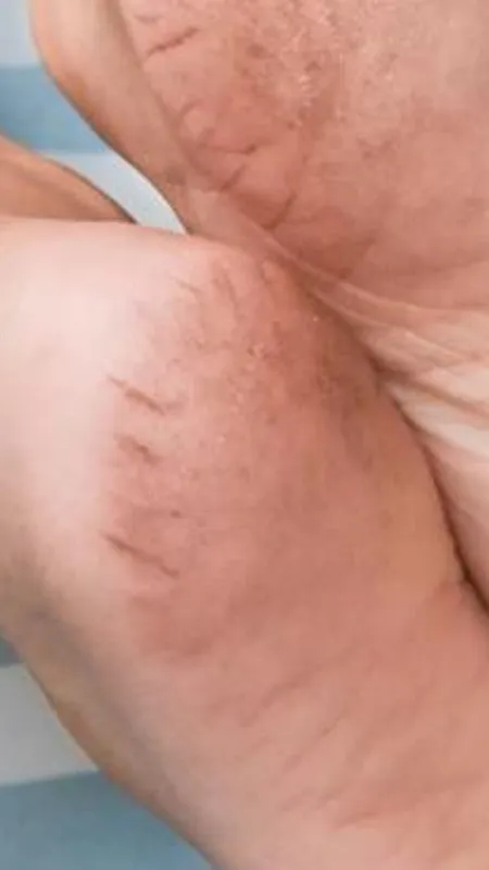 फटी एड़ियां जाएंगी जुड़, मोमबत्ती का इस तरह से इस्तेमाल है एकदम good