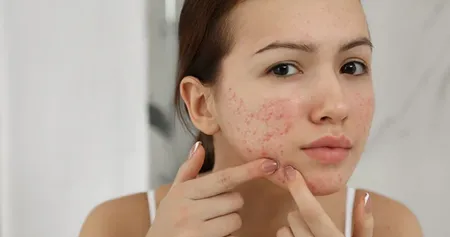 acne adn pimp.jpg