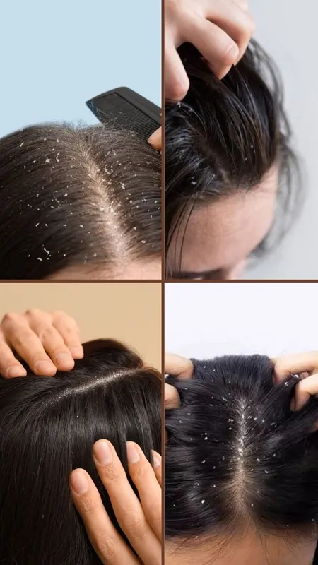 सर्दियों में डैंड्रफ क्यों बढ़ती है? इन गलतियों से बचें और पाएं साफ़–स्वस्थ बाल