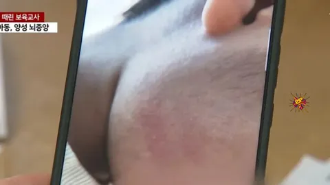 Teacher at Korean Daycare Abuses Child with Brain Tumor, Sparking Outrage