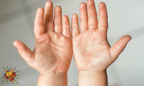 Tomato Flu: A Contagious disease spreads all throughout Haryana, Tamil Nadu and Odisha