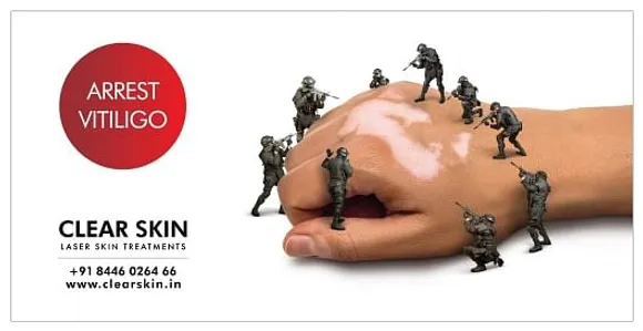 ARREST VITILIGO
