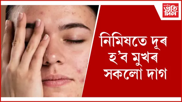 মুখৰ  দাগ seo