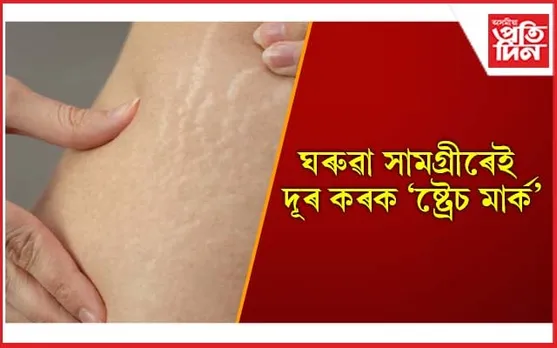 এতিয়া ‘ষ্ট্ৰেচ মাৰ্ক’ৰ সমস্যাৰ বাবে চিন্তাৰ কাৰণ নাই