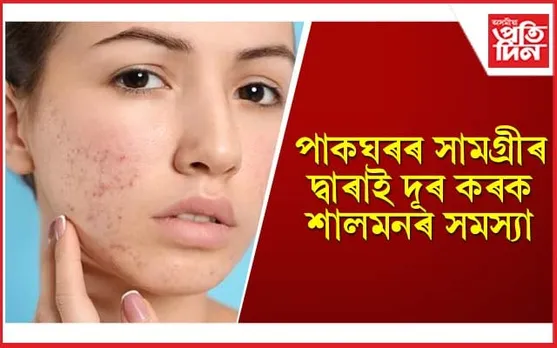 শালমন দূৰ কৰাৰ ঘৰুৱা উপায়বোৰ জানেনে ?