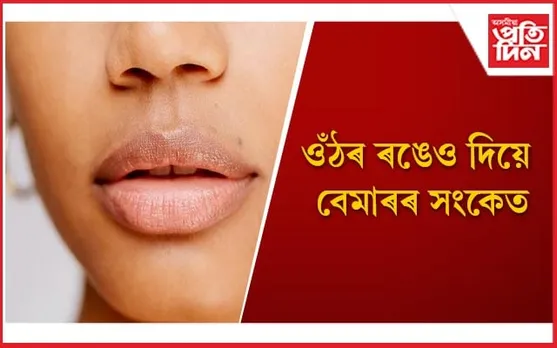 সতৰ্ক হ'ব, ওঁঠৰ ৰং সলনি হোৱাটো এই ৪ ৰোগৰ লক্ষণ