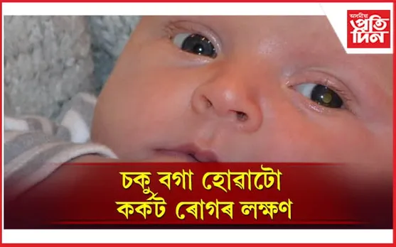 চকুৰ কৰ্কট ৰোগত আক্ৰান্ত পাঁচ মহীয়া শিশু, অভিভাৱকসকল সাৱধান হওঁক