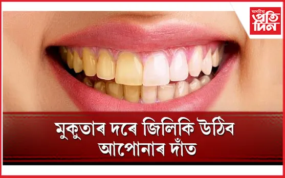 হালধীয়া দাঁতৰ বাবে লাজত পৰিছে  যদি এইসমূহ ঘৰুৱা উপায় অৱলম্বন কৰক