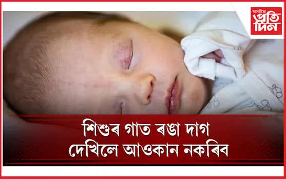অভিভাৱকসকল সাৱধান হওঁক ! ই এক ৰোগৰ লক্ষণ  
