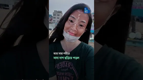 Vitiligo আমার দুর্বলতা নয় এটা আমার পরিচয় | Dolon Mukherjee | Vitiligo Model | Breaking Stereotypes