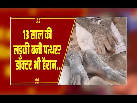 वो दुर्लभ बीमारी जिसने 13 साल की बच्ची को बना दिया 'स्टोन गर्ल', दुनिया में सिर्फ 24 मरीज!