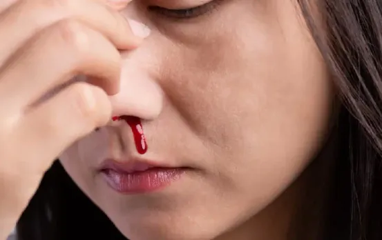 Summer Nose Bleeding Prevention Tips