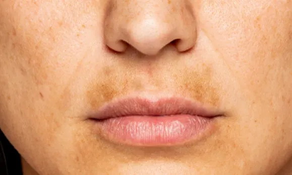 Darkness Around Lips: होठों के आस-पास होने वाले कालेपन को मिनटों में ऐसे करें दूर, बस स्किनकेयर में करें छोटे बदलाव
