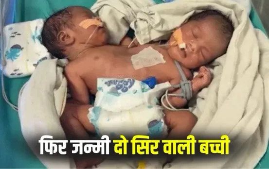 Indore Conjoined Twins