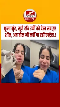 उर्फी जावेद के चेहरा का हुआ बुरा हाल, 9 साल बाद हटवाए फिलर्स तो हुआ बुरा हाल