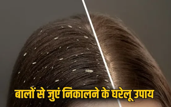 Hair Lice Home Remedies: बारिश में बालों में हो गए हैं जुएं? इन घरेलू नुस्खों से सिर्फ 1 हफ्ते में करें लीख का सफाया