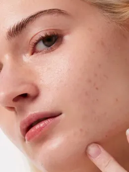 White Head Remover Tips