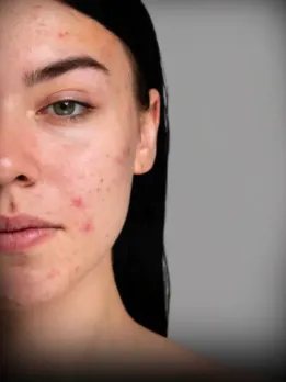 acne removal home remedies