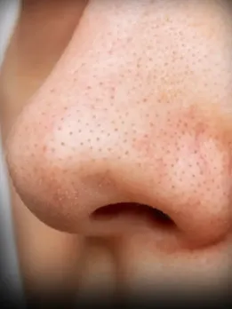 blackheads