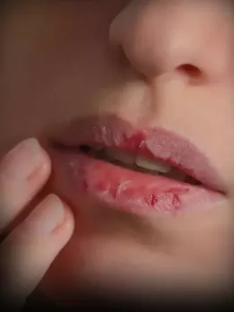 dry lips
